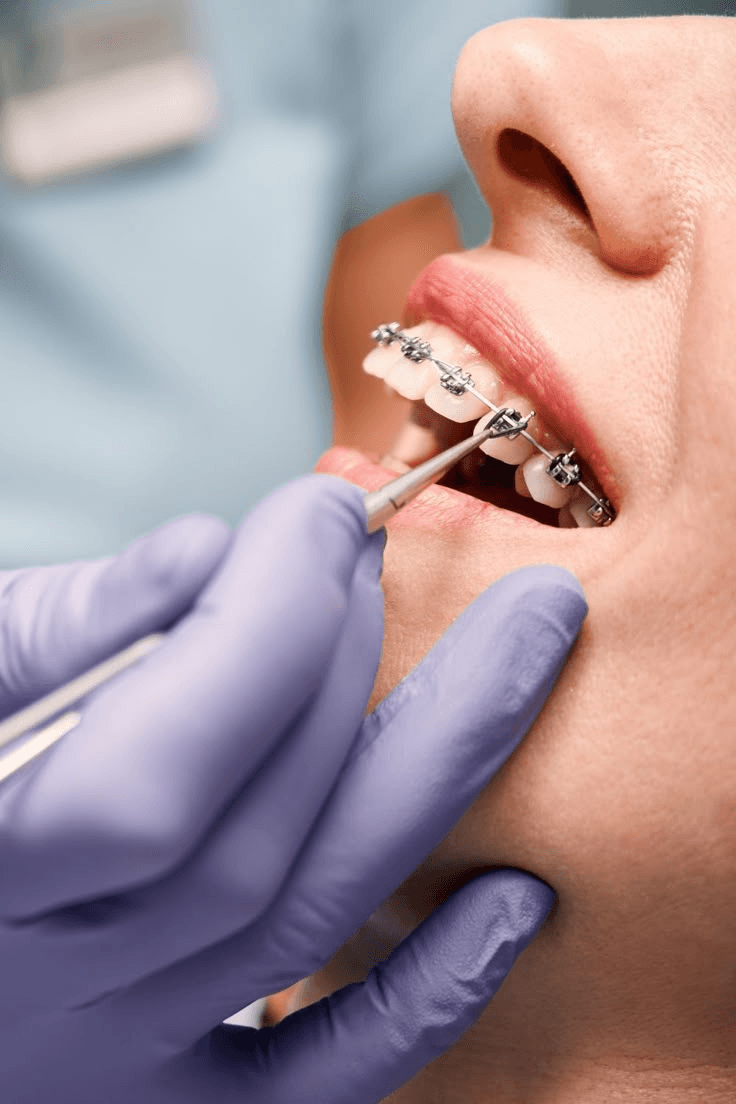 Braces Treatment Image