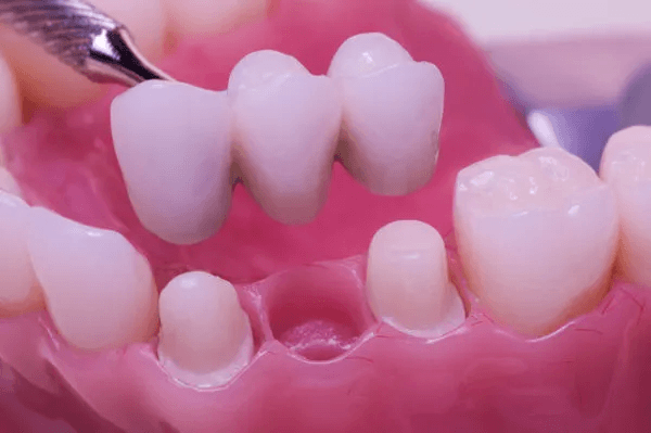 Crown, Bridge, Veneers