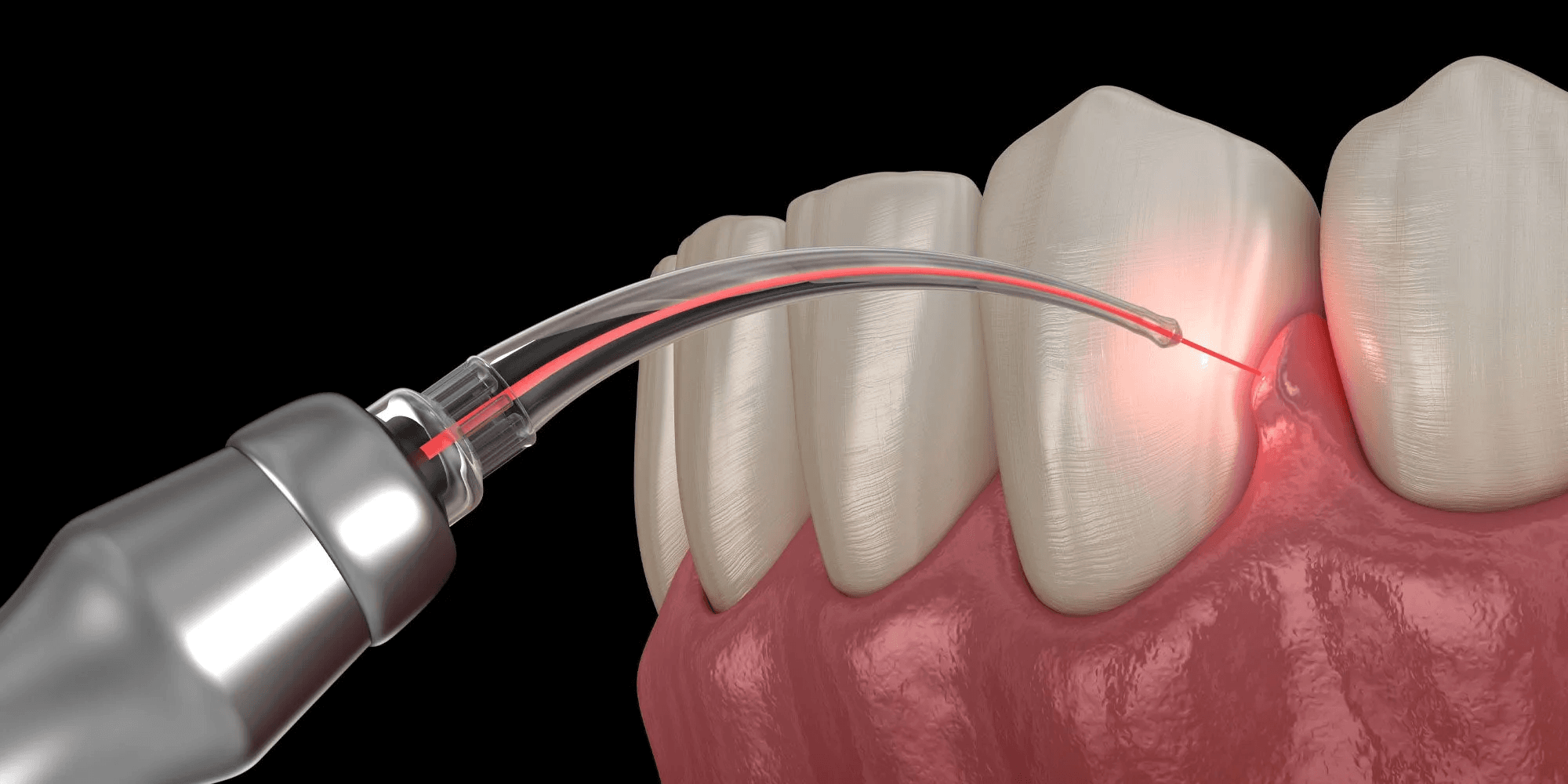 Laser Dental Procedures