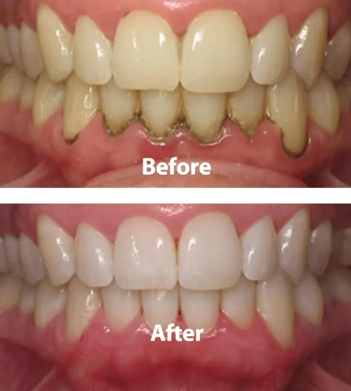 Periodontal Treatment
