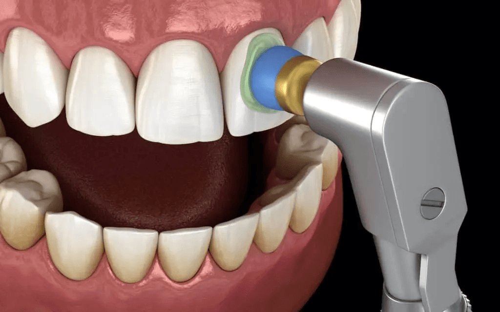 Teeth Scaling and Polishing